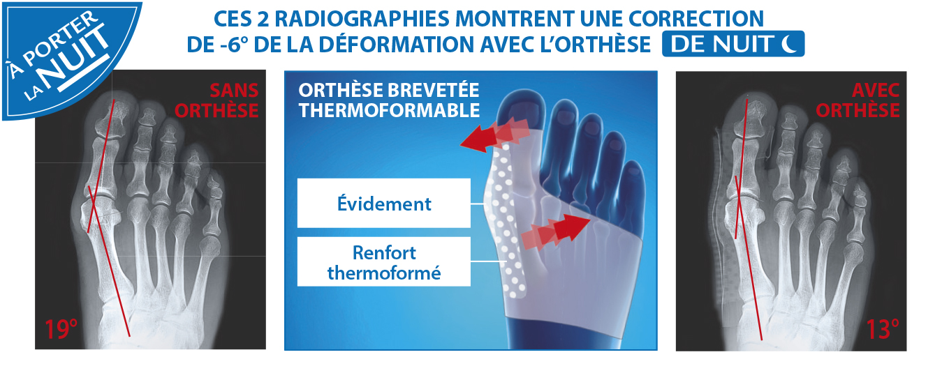 Hallux Valgus 